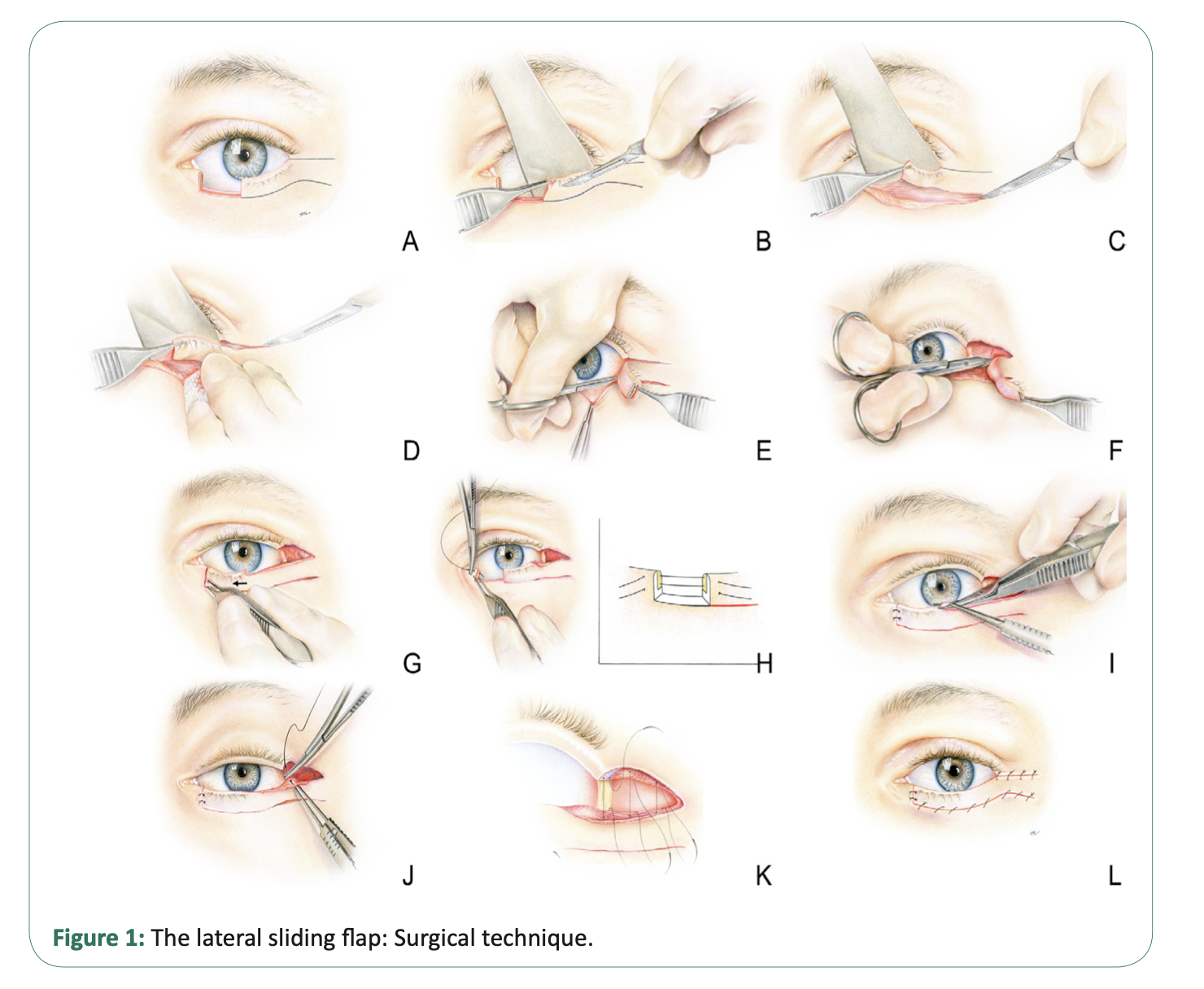 Lateral sliding flap for one-step reconstruction of medium-sized eyelid defects (eyelid reconstruction)